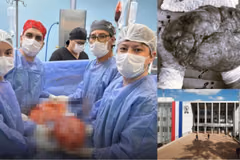 Extirpan tumor de 14 kilos en hospital del IPS