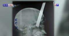 Guardia termina con una varilla en el cráneo tras discusión