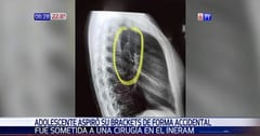 Someten a intervención a adolescente que tragó parte de su frenillo