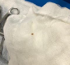 Niño que tragó cáscara de huevo llegó a estar en terapia, reportan