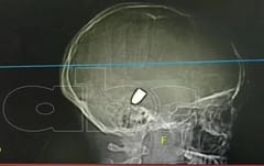 Adolescente está en coma inducido víctima de bala perdida