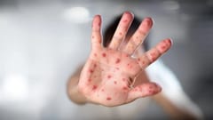 Posible caso de viruela del mono detectado en Encarnación, Itapúa