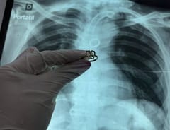 Ineram: extraen anillo de oro del pulmón de paciente