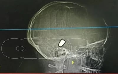 Adolescente está en coma inducido víctima de bala perdida