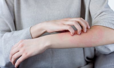 Dermatitis Atópica: Avances prometedores contra un malestar crónico