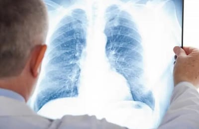 Alerta roja: El silencioso azote del cáncer de pulmón