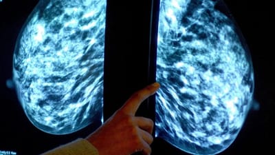 Radioterapia contra el cáncer de mama: beneficios a largo plazo