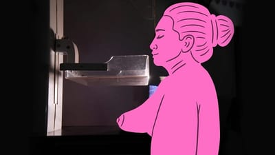 Alarma en Paraguay: 10 mujeres mueren cada semana por cáncer de mama