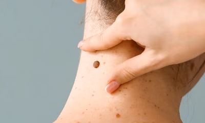 Clínicas ofrece consultas gratuitas para prevenir cáncer de piel