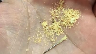 Denuncian aguja en chipita del programa Hambre Cero