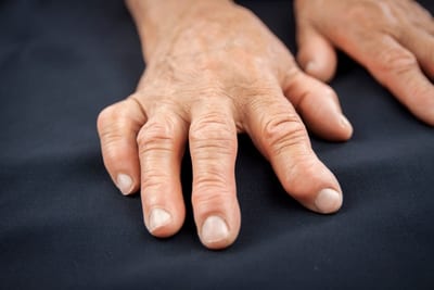 Tratamientos innovadores marcan un nuevo rumbo en la artritis reumatoide