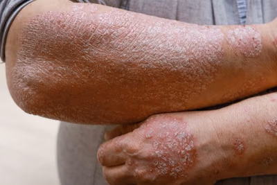 Psoriasis: organizan jornada gratuita para pacientes y familias
