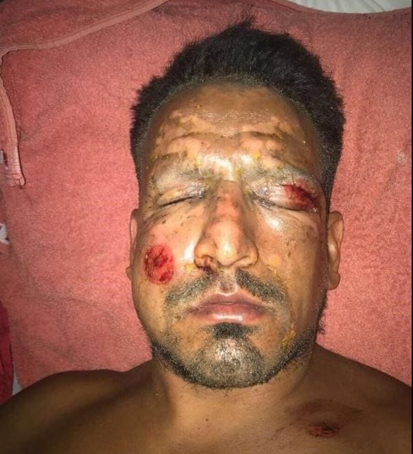 Futbolista sufre graves quemaduras en accidente de pirotecnia