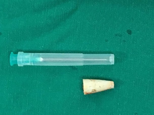 Niño vivió cuatro años con una tapa de bolígrafo en el pulmón