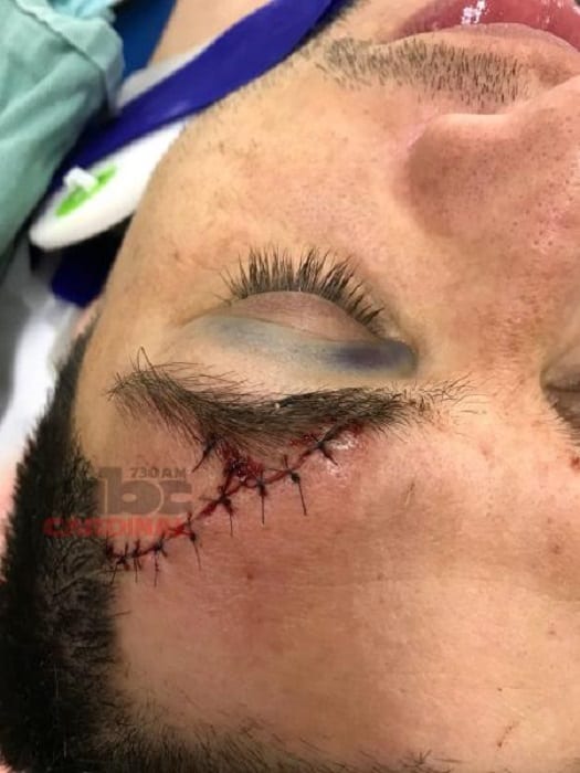 Impactante imagen del corte que sufrió Rodrigo Rojas