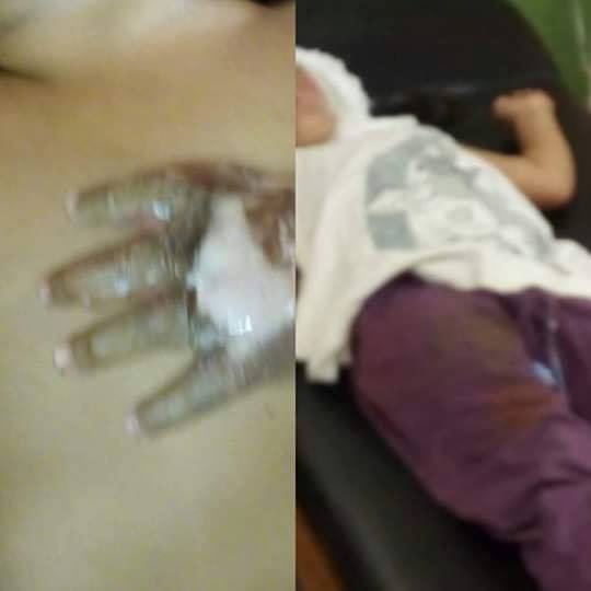 Bebés sufren quemaduras con aceite caliente