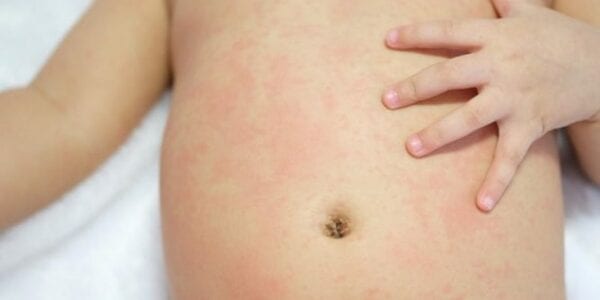 La meningitis: Una enfermedad grave y contagiosa explicada en 10 datos