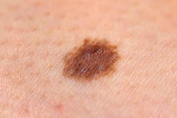 ¿Qué es el melanoma?: 10 datos para detectar a tiempo el tipo de cáncer