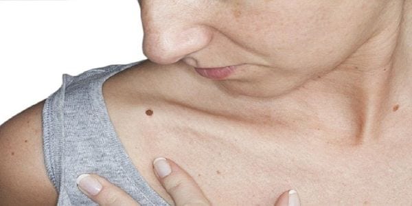 ¿Qué es el melanoma?: 10 datos para detectar a tiempo el tipo de cáncer