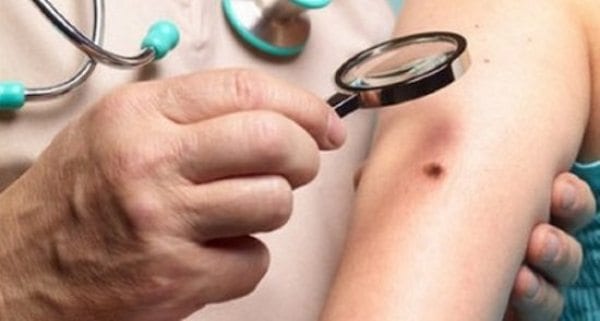 ¿Qué es el melanoma?: 10 datos para detectar a tiempo el tipo de cáncer