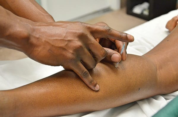 Acupuntura en la salud pública: 10 datos para saber de qué se trata