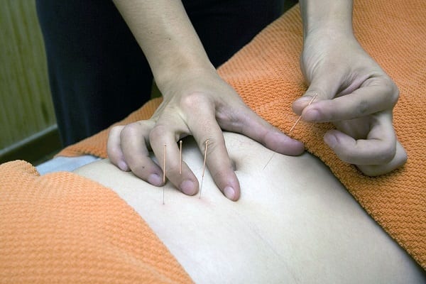 Acupuntura en la salud pública: 10 datos para saber de qué se trata