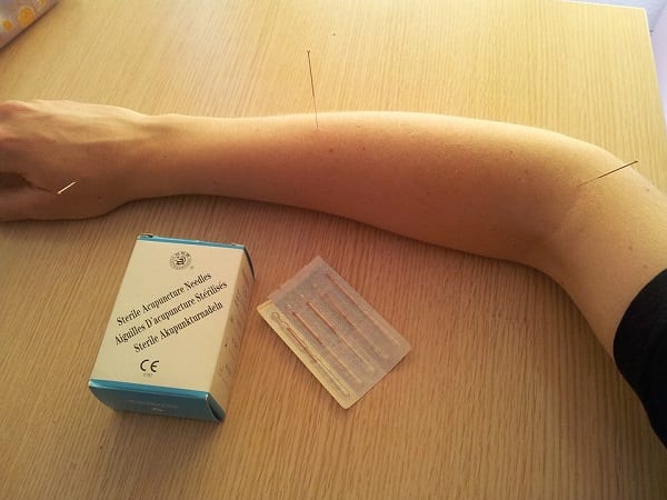Acupuntura en la salud pública: 10 datos para saber de qué se trata