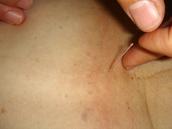 Acupuntura en la salud pública: 10 datos para saber de qué se trata