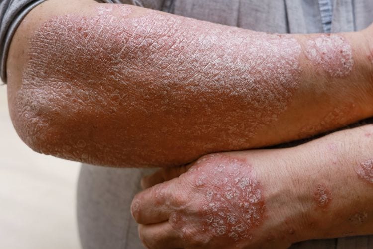 Imagen de la cobertura: Psoriasis: organizan jornada gratuita para pacientes y familias