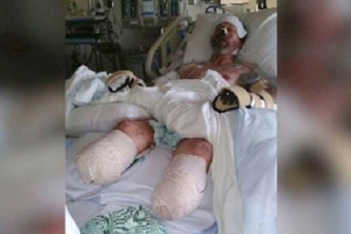 Hombre pierde sus extremidades a causa de lamida de un can