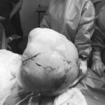 Proeza médica: extraen tumor de 9 kilos a paciente