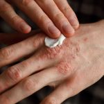 Día Mundial de la Psoriasis: romper el estigma y sanar