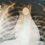 Exitosa extracción de moneda a niña de tres años en Ineram