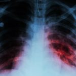 Día Mundial alerta sobre impacto de la tuberculosis