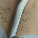 Paciente escribió en su pierna para evitar error médico