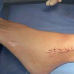 Mujer sufrió doble fractura tras caer en un bache