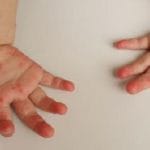 Enfermedad mano-pie-boca: síntomas y medidas para evitar contagios